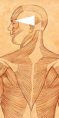Acupuncture Bl2 Zan Zhu Bladder Meridian